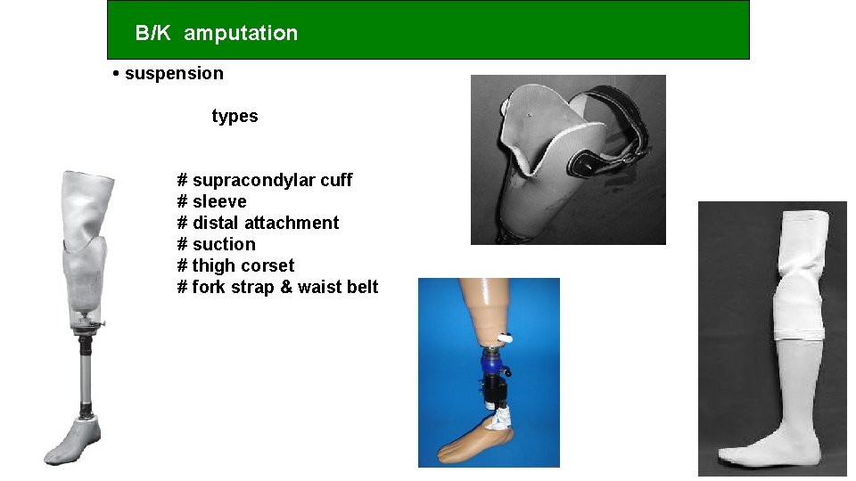 B/K amputation • suspension types # supracondylar cuff # sleeve # distal attachment #