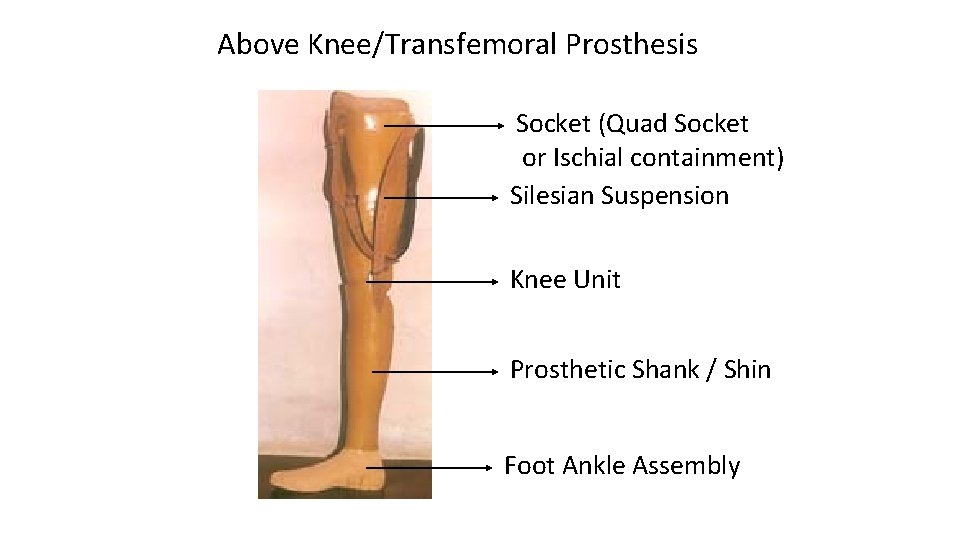 Above Knee/Transfemoral Prosthesis Socket (Quad Socket or Ischial containment) Silesian Suspension Knee Unit Prosthetic