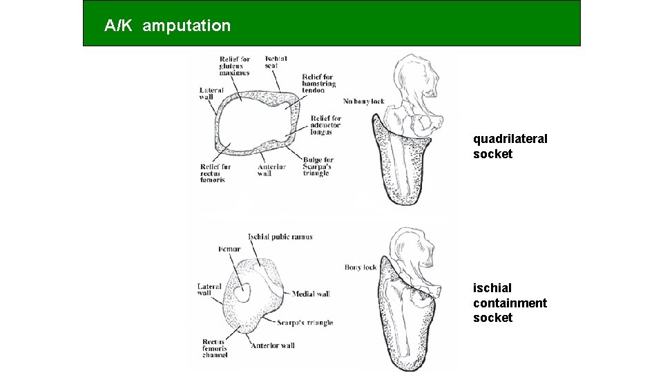 A/K amputation quadrilateral socket ischial containment socket 