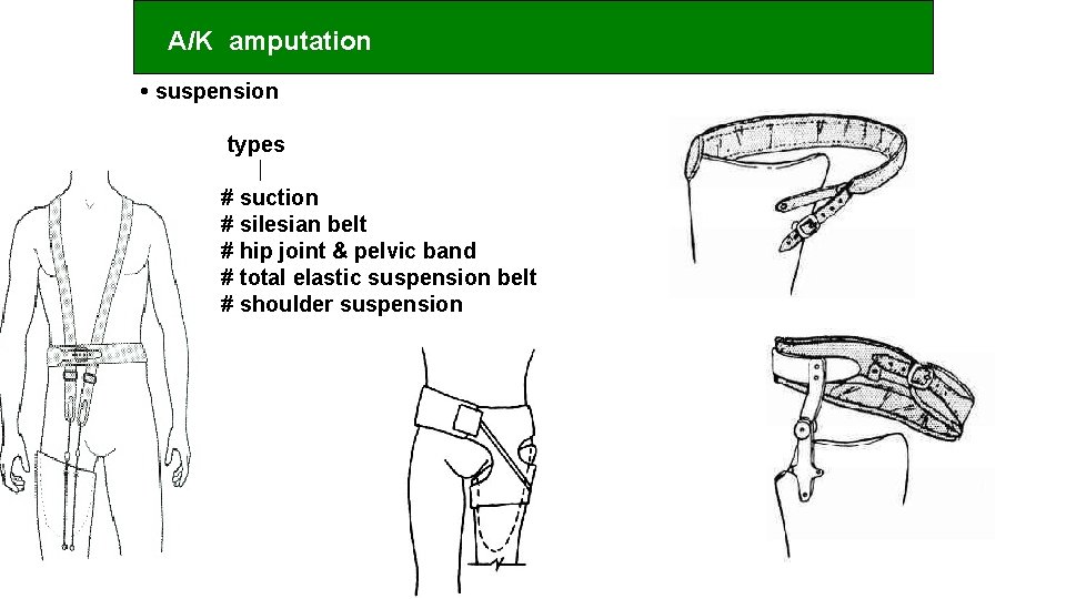 A/K amputation • suspension types # suction # silesian belt # hip joint &
