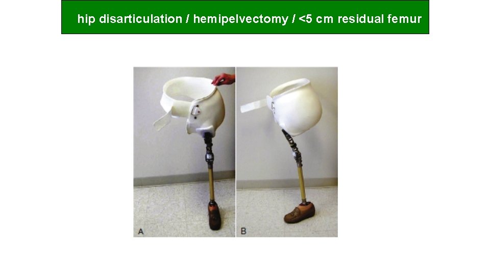 hip disarticulation / hemipelvectomy / <5 cm residual femur 