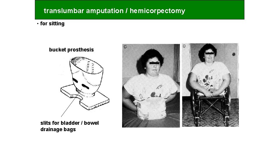 translumbar amputation / hemicorpectomy • for sitting bucket prosthesis slits for bladder / bowel