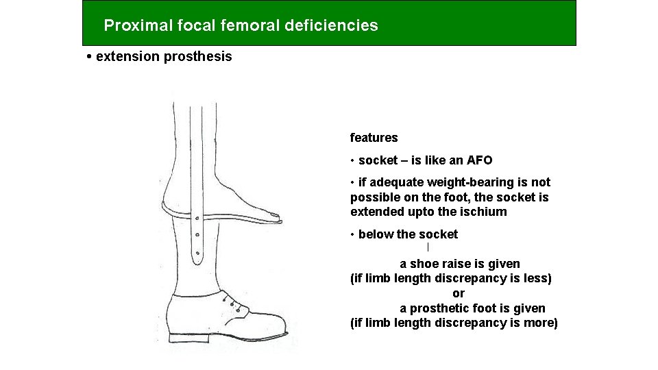 Proximal focal femoral deficiencies • extension prosthesis features • socket – is like an