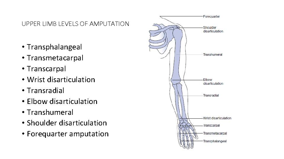 UPPER LIMB LEVELS OF AMPUTATION • Transphalangeal • Transmetacarpal • Transcarpal • Wrist disarticulation