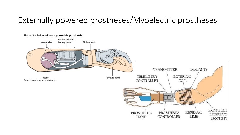 Externally powered prostheses/Myoelectric prostheses 