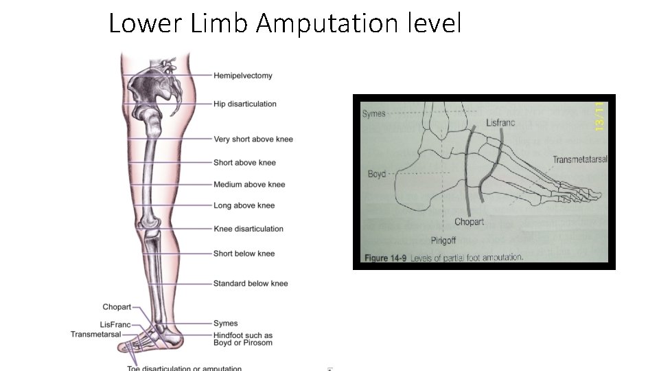 Lower Limb Amputation level 