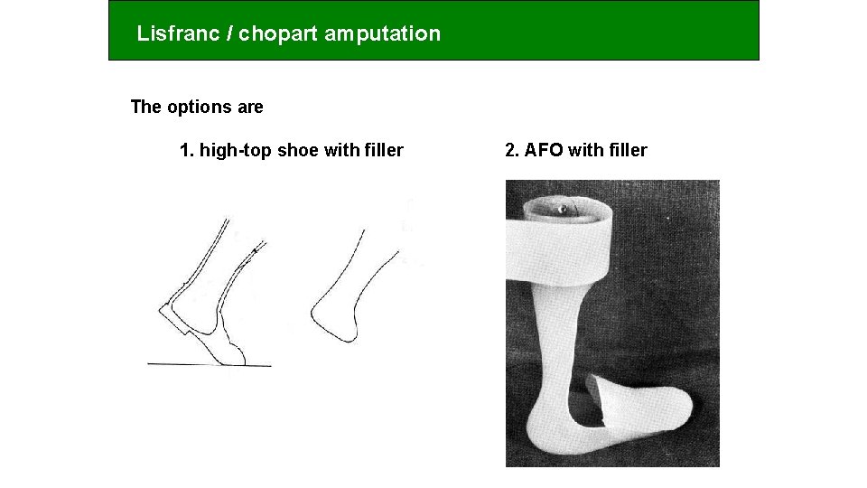 Lisfranc / chopart amputation The options are 1. high-top shoe with filler 2. AFO