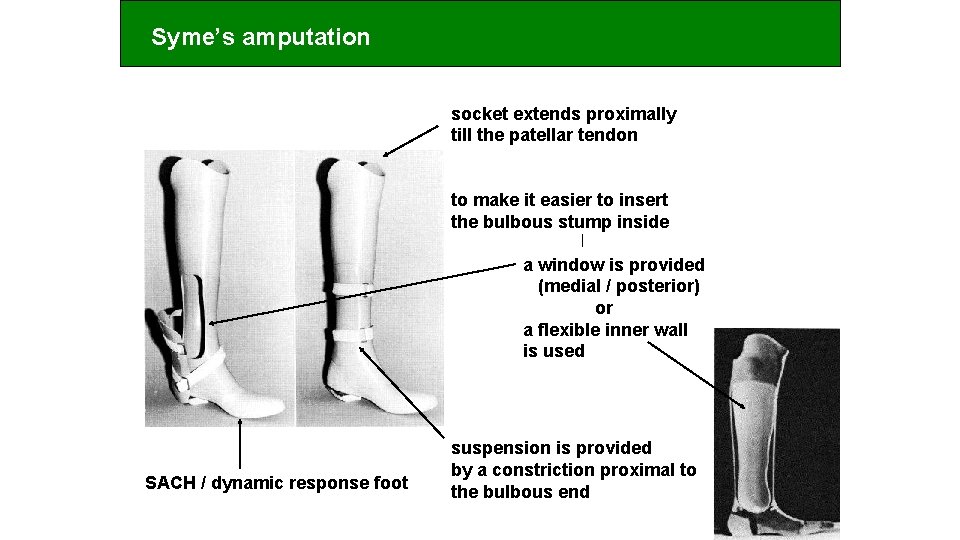 Syme’s amputation socket extends proximally till the patellar tendon to make it easier to