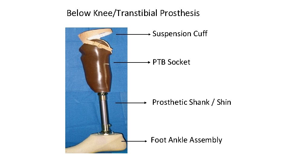 Below Knee/Transtibial Prosthesis Suspension Cuff PTB Socket Prosthetic Shank / Shin Foot Ankle Assembly