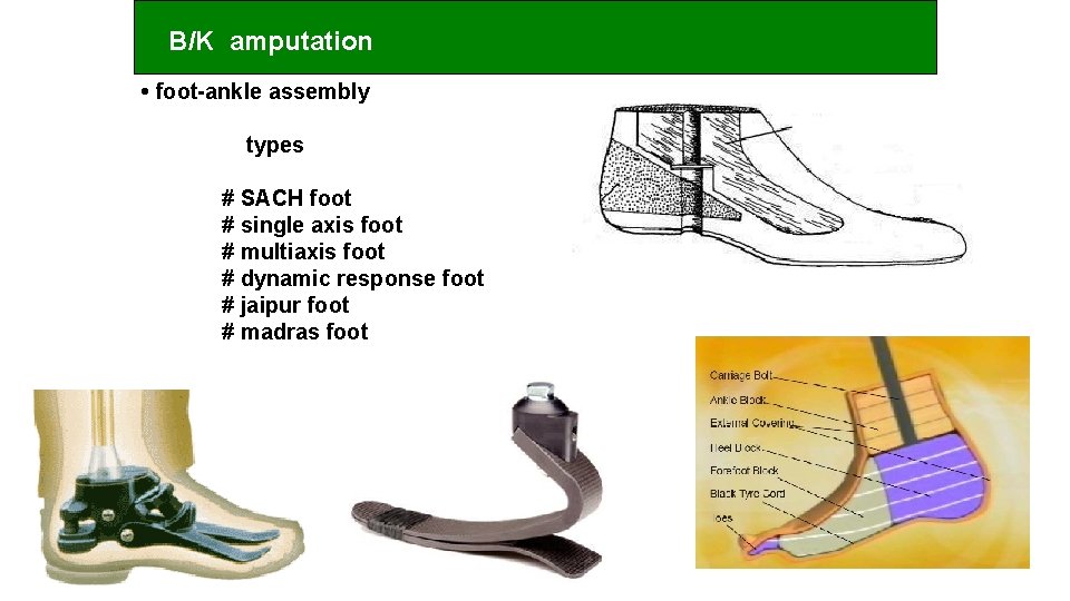 B/K amputation • foot-ankle assembly types # SACH foot # single axis foot #