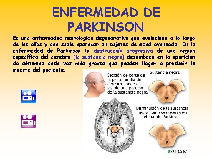 ENFERMEDAD DE PARKINSON Es una enfermedad neurológica degenerativa que evoluciona a lo largo de