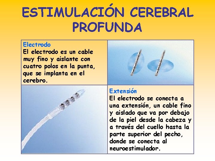 ESTIMULACIÓN CEREBRAL PROFUNDA Electrodo El electrodo es un cable muy fino y aislante con