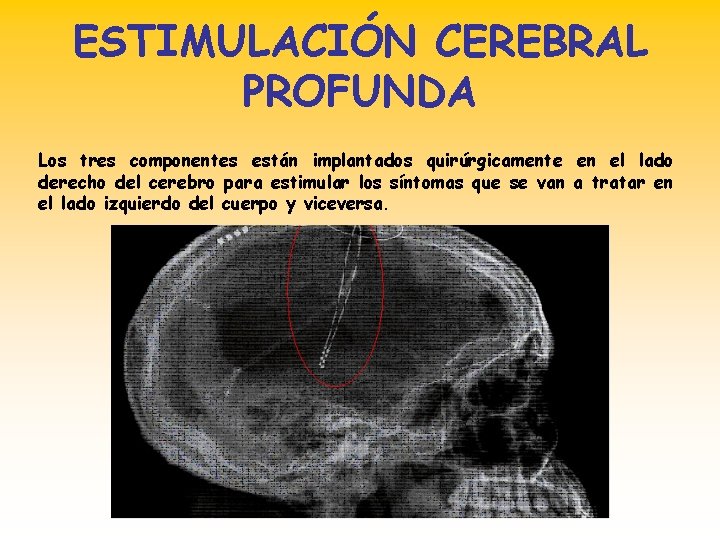 ESTIMULACIÓN CEREBRAL PROFUNDA Los tres componentes están implantados quirúrgicamente en el lado derecho del