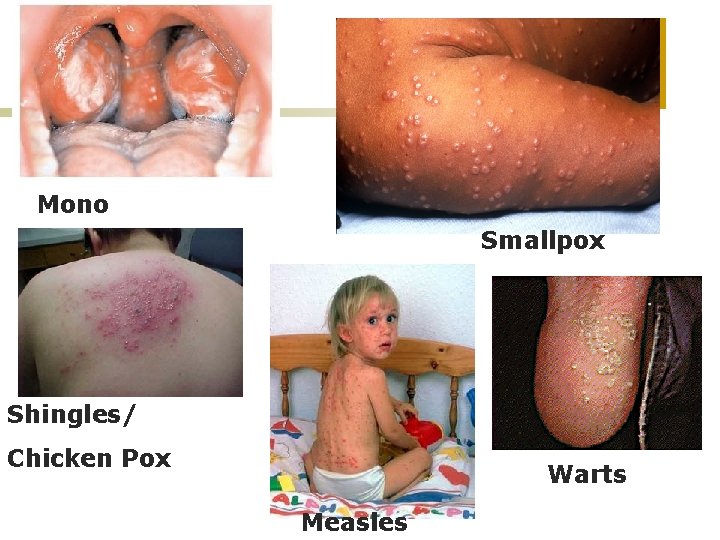 Mono Smallpox Shingles/ Chicken Pox Warts Measles 