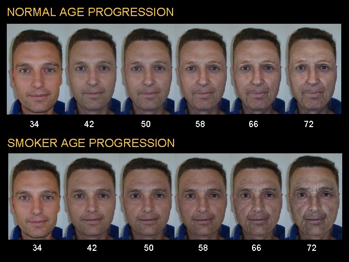 NORMAL AGE PROGRESSION 34 42 50 58 66 72 SMOKER AGE PROGRESSION 34 42