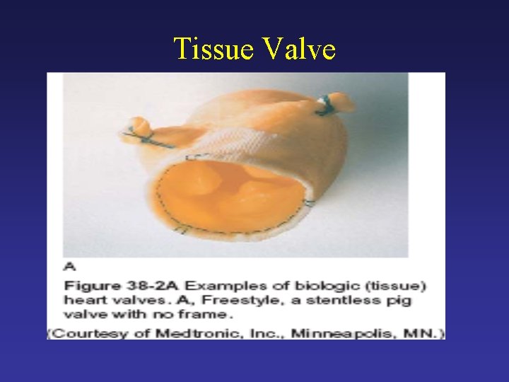 Tissue Valve 