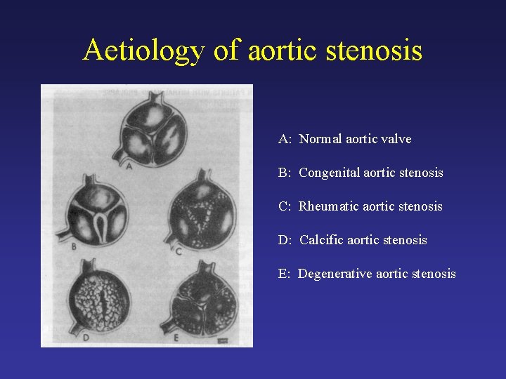 Aetiology of aortic stenosis A: Normal aortic valve B: Congenital aortic stenosis C: Rheumatic