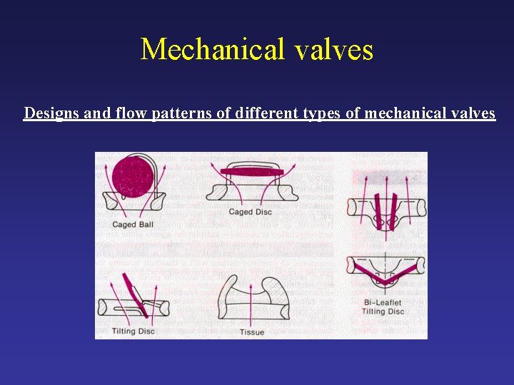 Mechanical valves Designs and flow patterns of different types of mechanical valves 