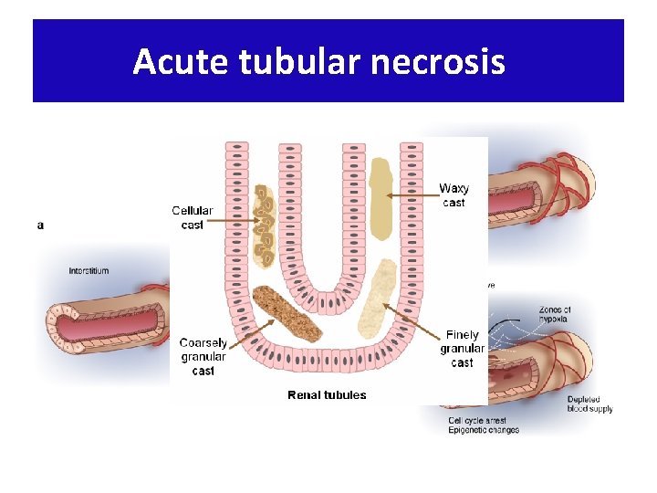 Acute tubular necrosis 