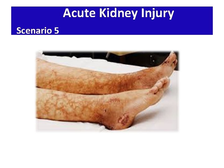 Acute Kidney Injury Scenario 5 