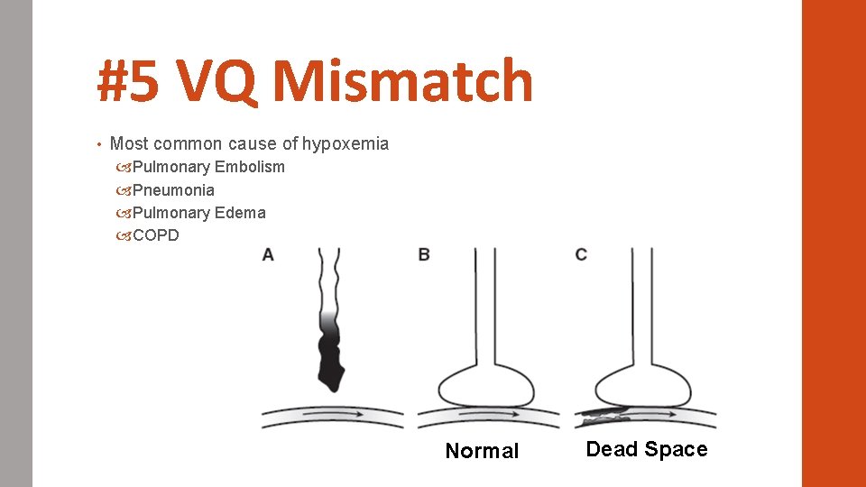#5 VQ Mismatch • Most common cause of hypoxemia Pulmonary Embolism Pneumonia Pulmonary Edema