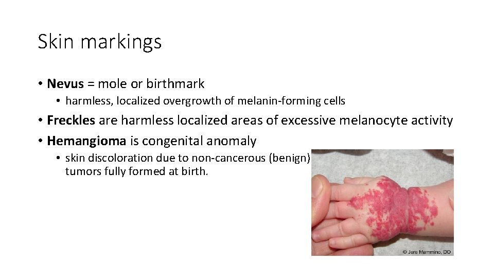 Skin markings • Nevus = mole or birthmark • harmless, localized overgrowth of melanin-forming