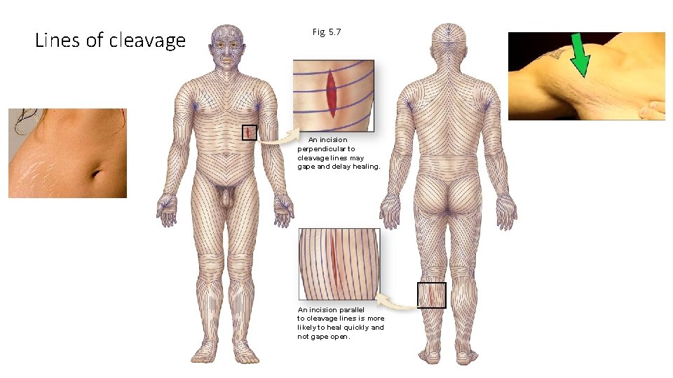 Lines of cleavage Fig. 5. 7 An incision perpendicular to cleavage lines may gape
