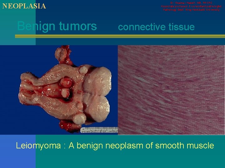 NEOPLASIA Benign tumors Dr. Osama I Nassif. MD, FRCPC. Associate professor & consultant pathologist.