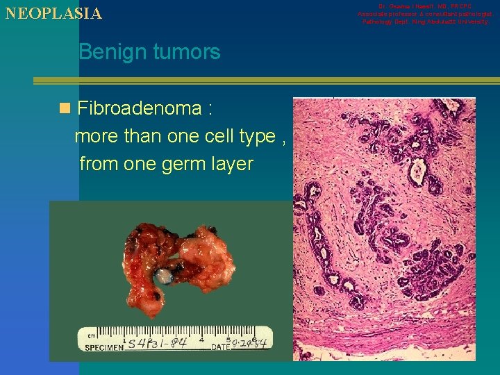 NEOPLASIA Benign tumors n Fibroadenoma : more than one cell type , from one