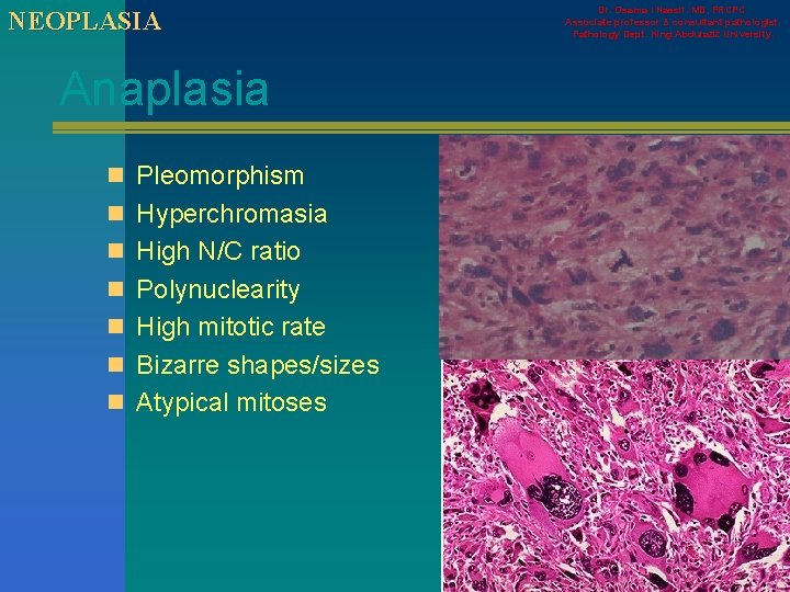 NEOPLASIA Anaplasia n Pleomorphism n Hyperchromasia n High N/C ratio n Polynuclearity n High