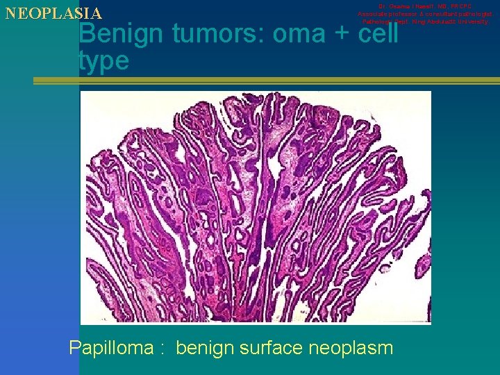 NEOPLASIA Dr. Osama I Nassif. MD, FRCPC. Associate professor & consultant pathologist. Pathology Dept.