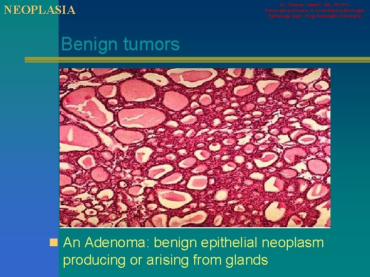 NEOPLASIA Dr. Osama I Nassif. MD, FRCPC. Associate professor & consultant pathologist. Pathology Dept.