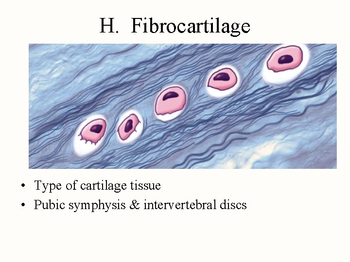 H. Fibrocartilage • Type of cartilage tissue • Pubic symphysis & intervertebral discs 