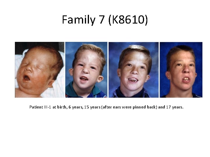 Family 7 (K 8610) Patient III-1 at birth, 6 years, 15 years (after ears