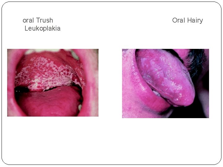 oral Trush Leukoplakia Oral Hairy 