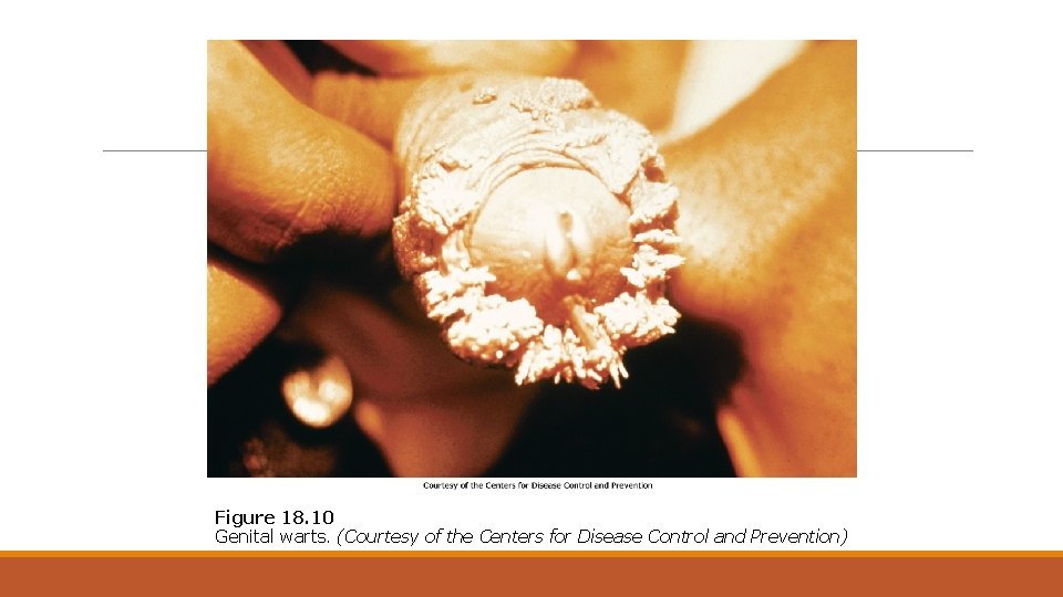 Figure 18. 10 Genital warts. (Courtesy of the Centers for Disease Control and Prevention)