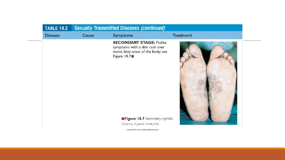 Table 18. 2 (continued) Sexually Transmitted Diseases 