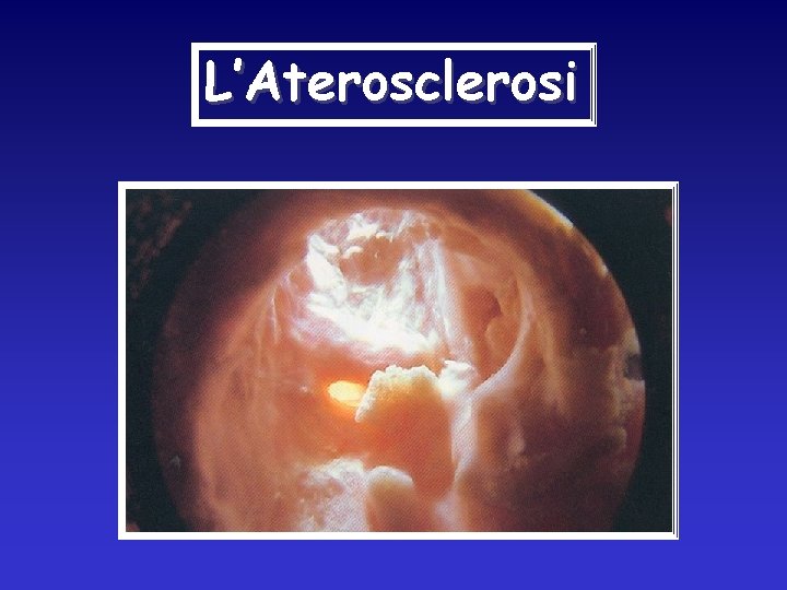 L’Aterosclerosi 