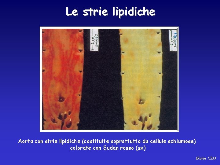 Le strie lipidiche Aorta con strie lipidiche (costituite soprattutto da cellule schiumose) colorate con