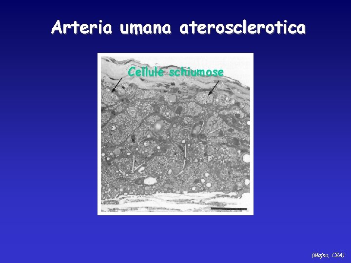 Arteria umana aterosclerotica Cellule schiumose (Majno, CEA) 