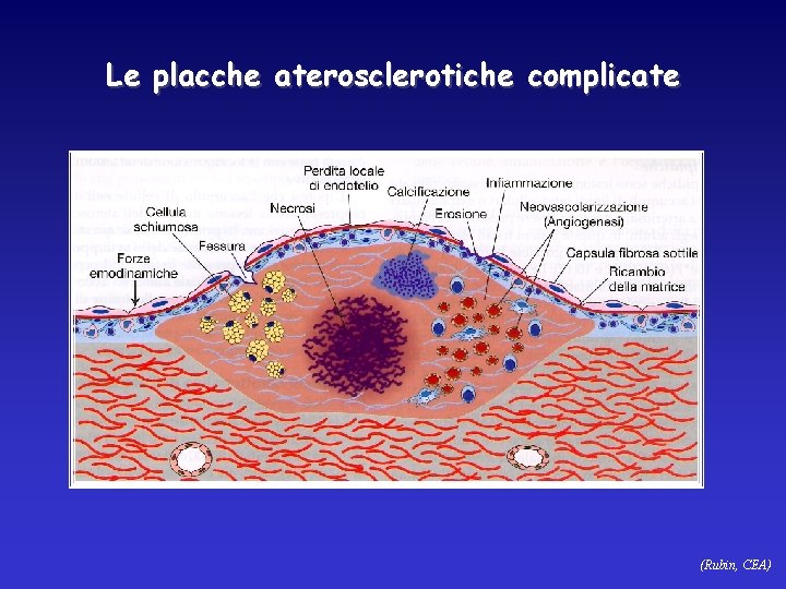 Le placche aterosclerotiche complicate (Rubin, CEA) 