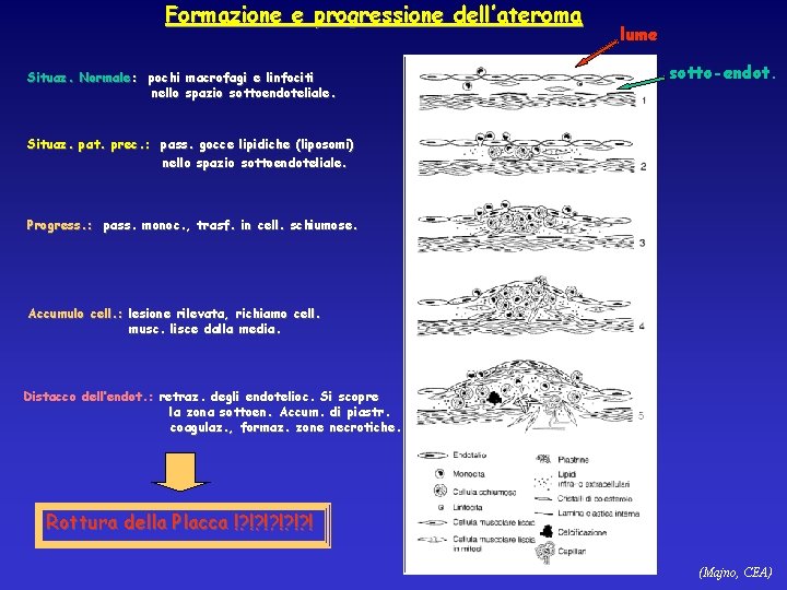 Formazione e progressione dell’ateroma Situaz. Normale: pochi macrofagi e linfociti nello spazio sottoendoteliale. lume