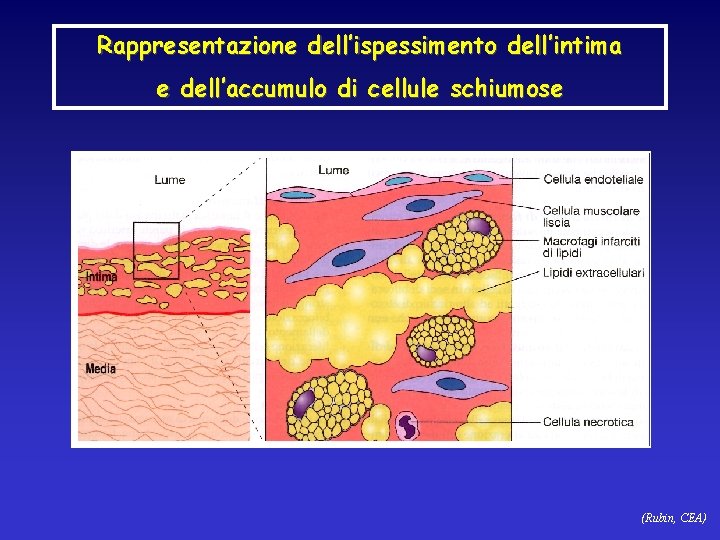 Rappresentazione dell’ispessimento dell’intima e dell’accumulo di cellule schiumose (Rubin, CEA) 