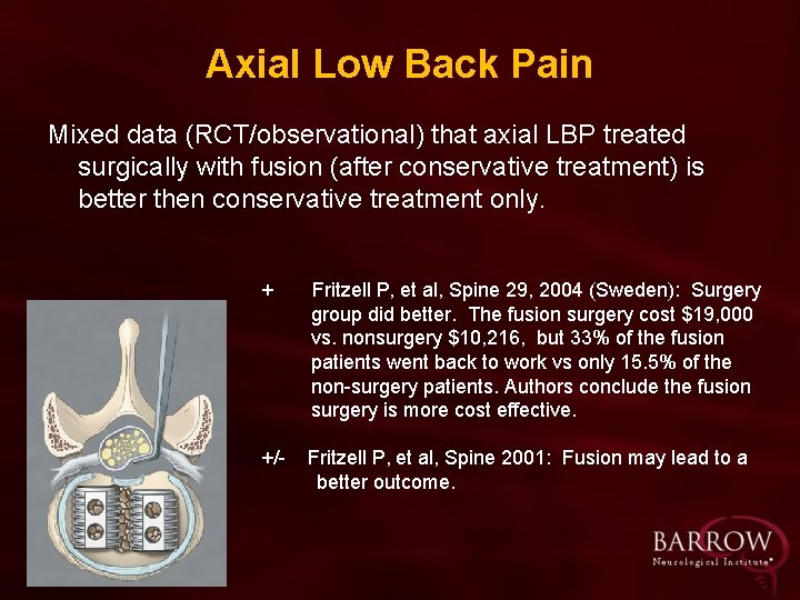 Axial Low Back Pain Mixed data (RCT/observational) that axial LBP treated surgically with fusion