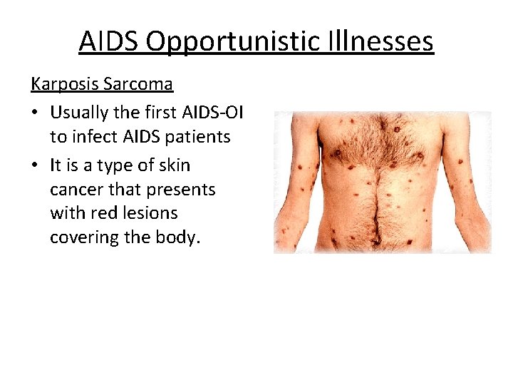 AIDS Opportunistic Illnesses Karposis Sarcoma • Usually the first AIDS-OI to infect AIDS patients