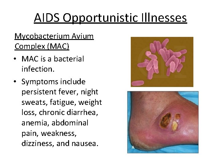 AIDS Opportunistic Illnesses Mycobacterium Avium Complex (MAC) • MAC is a bacterial infection. •