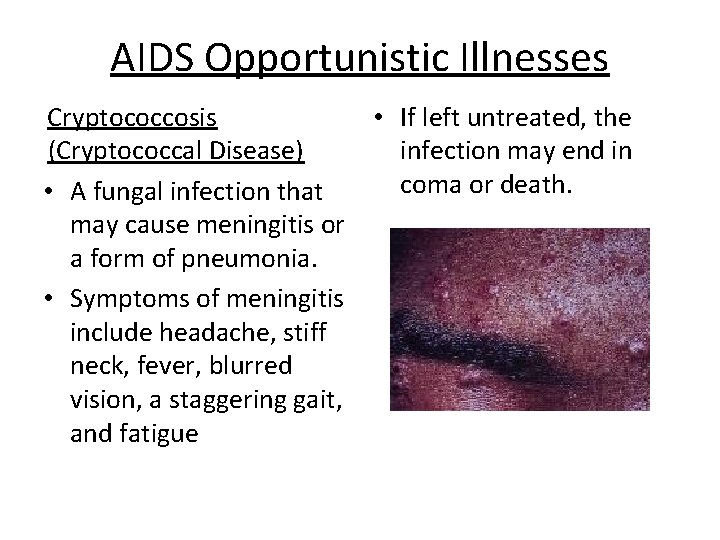 AIDS Opportunistic Illnesses Cryptococcosis (Cryptococcal Disease) • A fungal infection that may cause meningitis