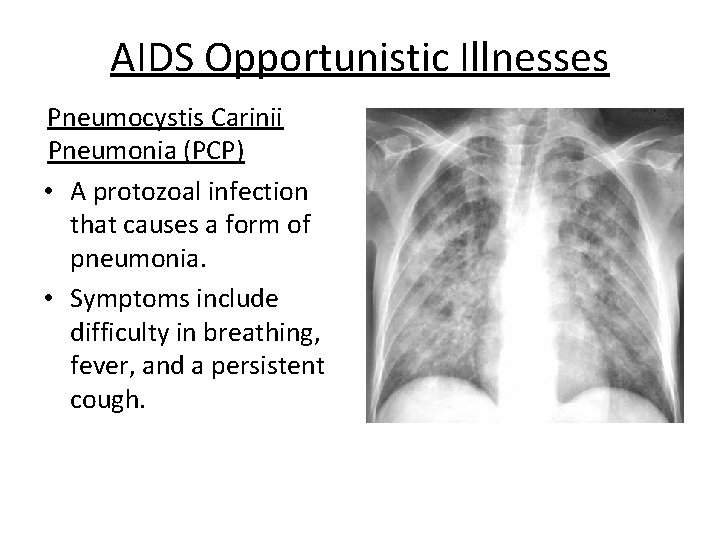AIDS Opportunistic Illnesses Pneumocystis Carinii Pneumonia (PCP) • A protozoal infection that causes a