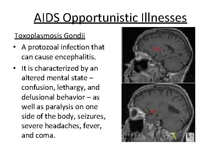 AIDS Opportunistic Illnesses Toxoplasmosis Gondii • A protozoal infection that can cause encephalitis. •