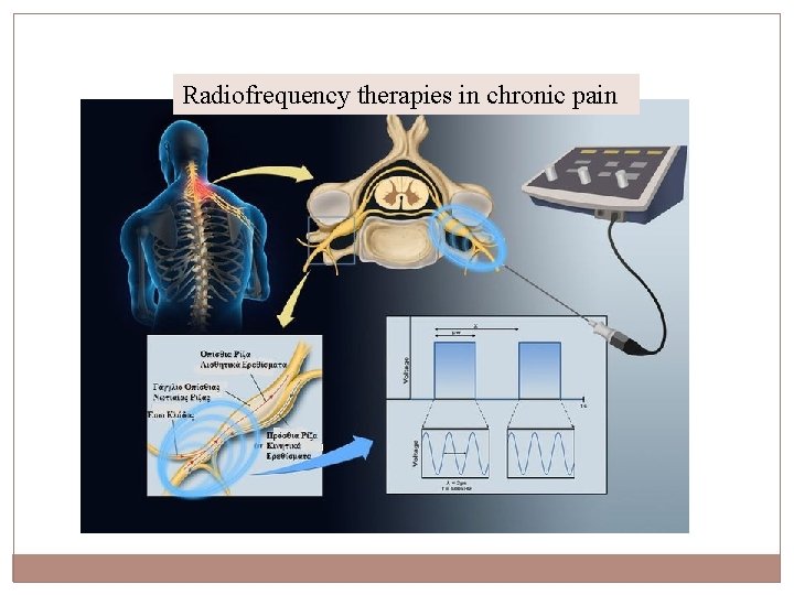 Radiofrequency therapies in chronic pain 